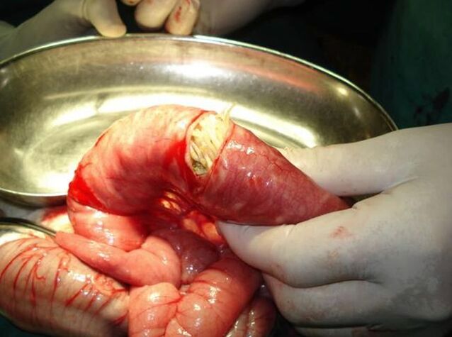 Würmer im menschlichen Darm