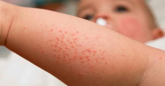 Hautausschlag als Symptom einer Parasiteninfektion