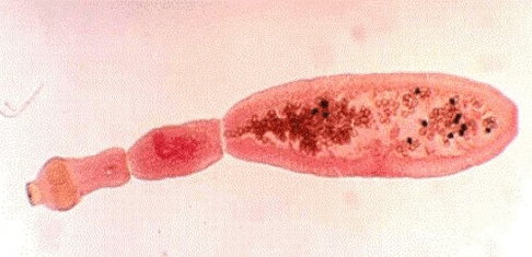 Wie sieht Echinococcus im menschlichen Körper aus 