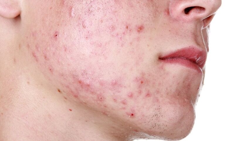 Hautausschlag im Gesicht durch Parasiten verursacht